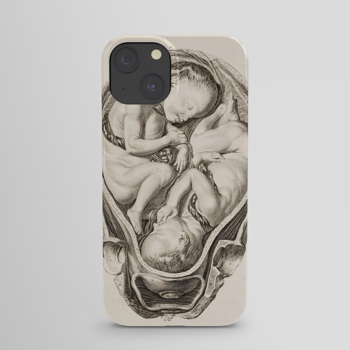 Twins in the Womb - Vintage Chart, 1765 iPhone Case