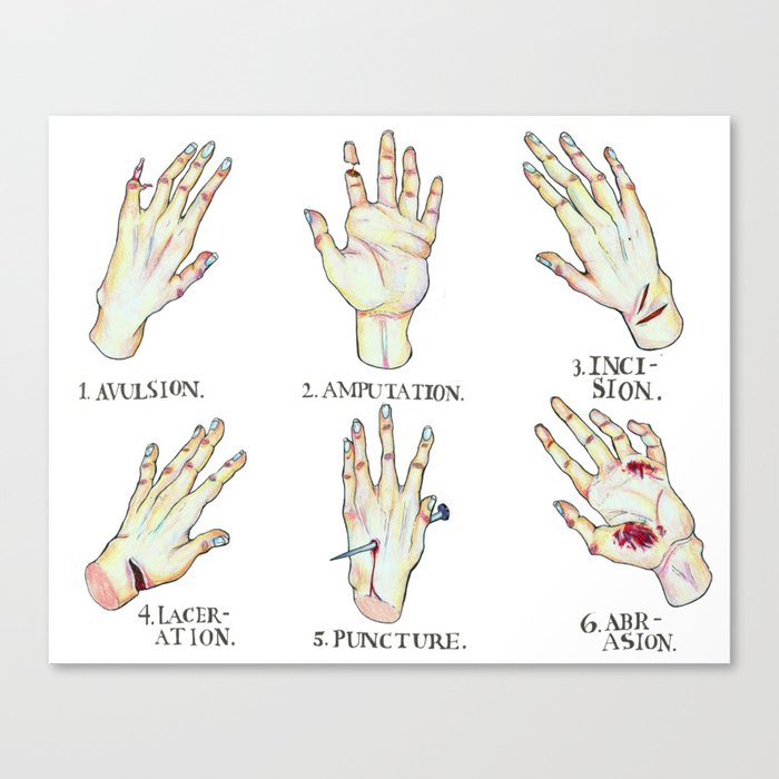 Open Wound Types Canvas Print