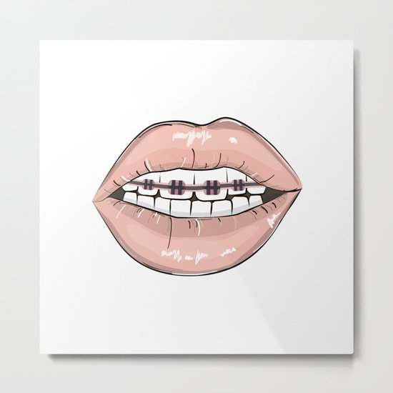 Lips vs braces Metal Print