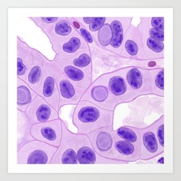 Papillary thyroid cancer histopathology watercolor art Art Print | Thyroid, Cancer, Pathology, Microscope, Digital, Histology, Watercolor, Painting, Science 