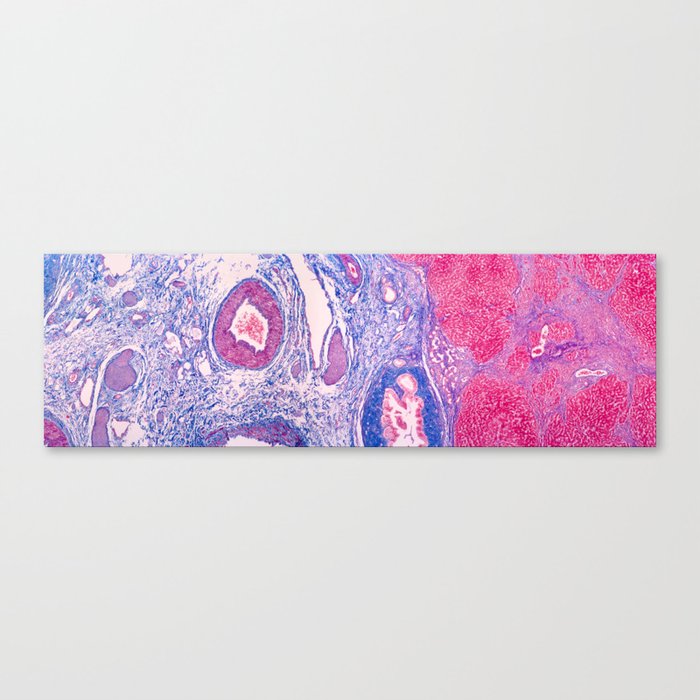 Cirrhosis of the Liver Canvas Print