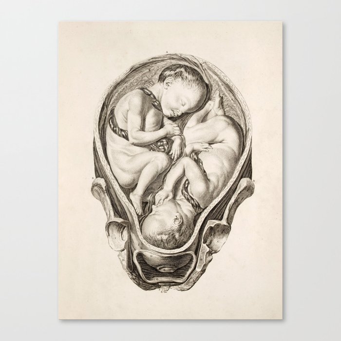 Twins in the Womb - Vintage Chart, 1765 Canvas Print